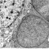 1F4 Oligodendroglia, satelliting (Case 5) EM1 - Copy