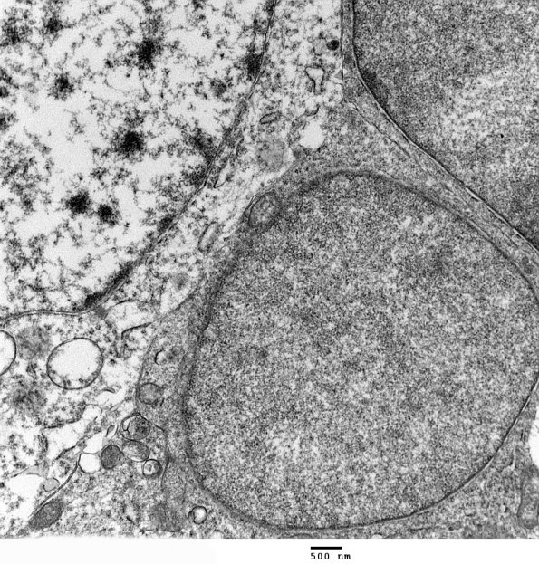 1F4 Oligodendroglia, satelliting (Case 5) EM1 - Copy