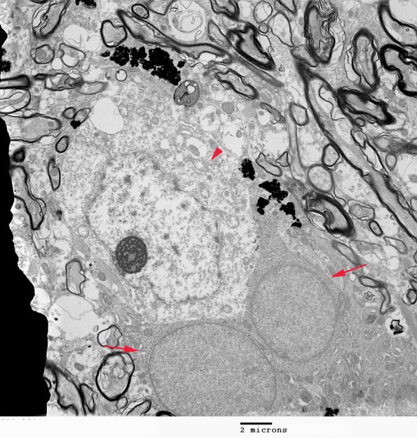 1F5 Oligodendroglia, satelliting (Case 5) EM 6 - Copy copy