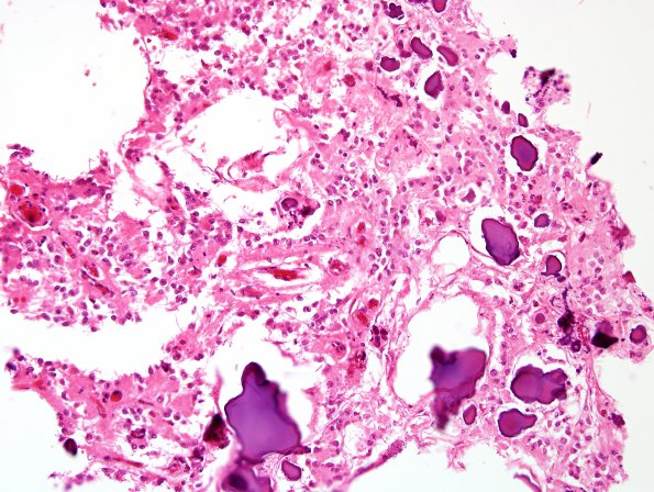 4A2 Pineal (Case 4) H&E 2