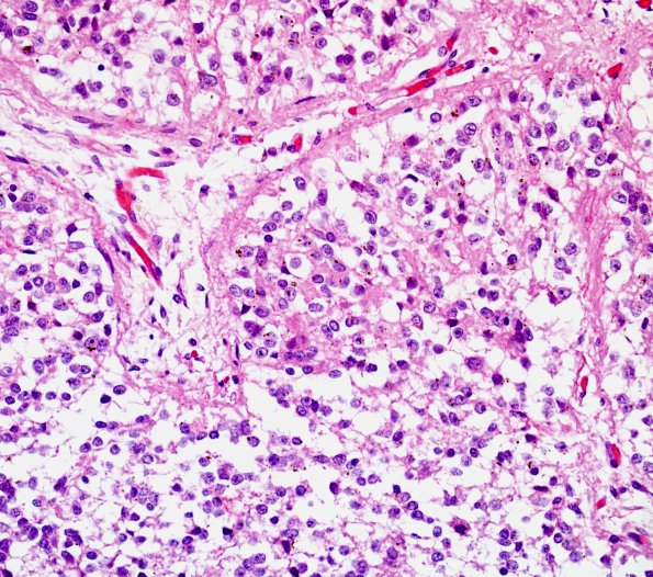5A3 Pineal (Case 5) H&E 1