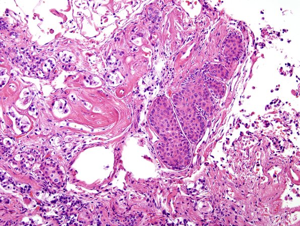 5C2 Pituitary stalk, squamous islands H&E 3