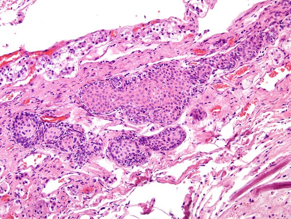 5C3 Pituitary stalk, squamous islands H&E 1