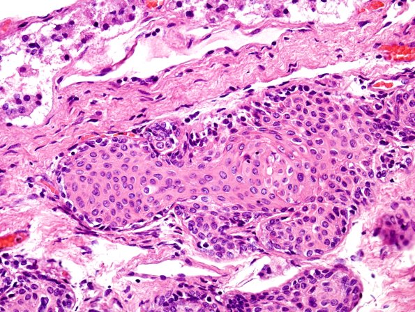 5C4 Pituitary stalk, squamous islands H&E 2