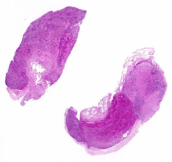 6B1 Pituitary, basophil invasion H&E WM