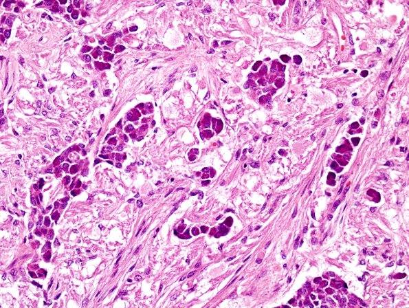 6B4 Pituitary, basophil invasion H&E 3
