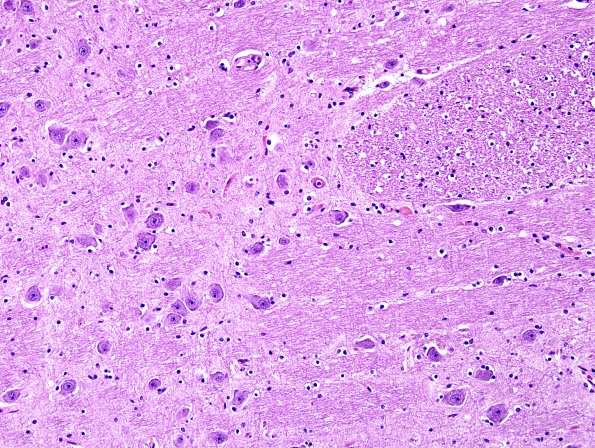 1A3 Pons, normal (Case 1A) H&E 1