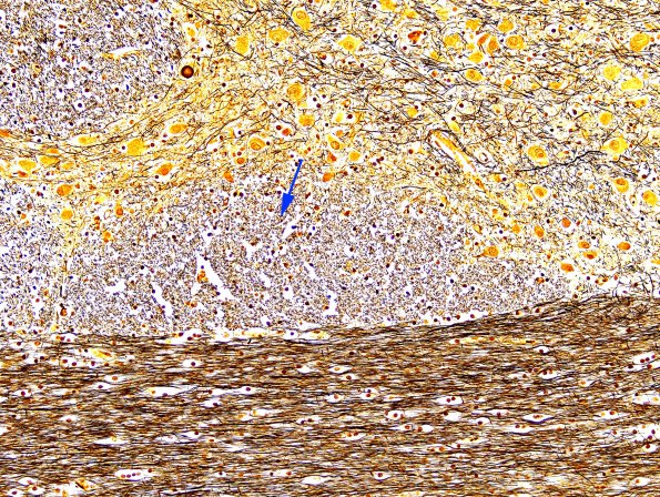 1C2 Pons, normal (Case 1A) Biels 1 copy