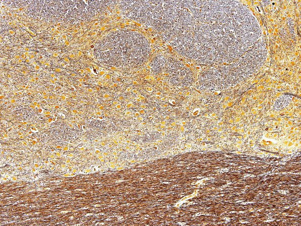 1C3 Pons, normal (Case 1A) Biels 2