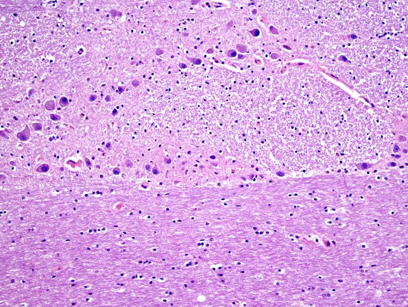 2A3 Pons, normal (Case 1A) H&E 2