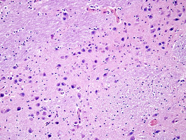 2A4 Pons, normal (Case 1A) H&E 1