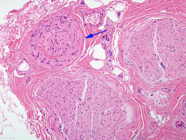10A1 Artifact vascular intussusception (Level 1) H&E 2 copy
