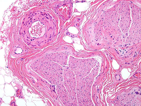10A2 Artifact vascular intusseception (Level 2) H&E 1