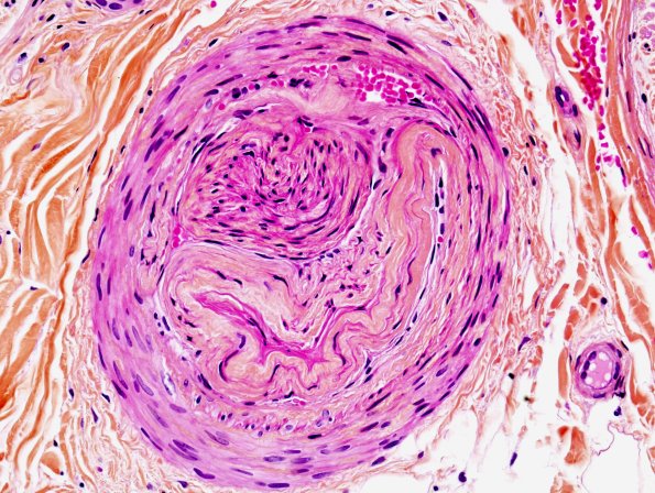 10B2 Artifact, crush Pentachrome 4