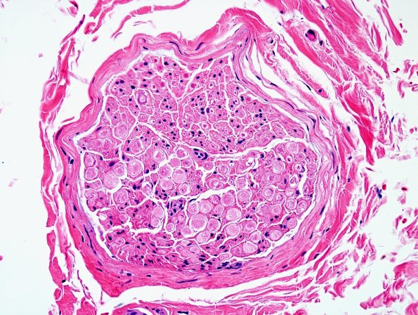 11B Artifact, crush H&E 2.jpg