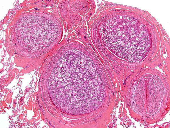 11C1 Artifact, Crush H&E 6.jpg