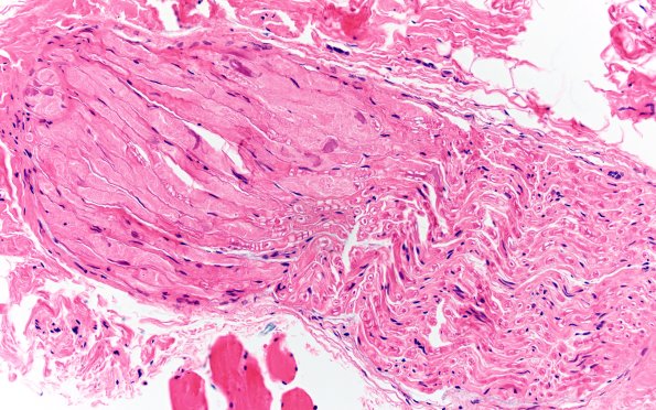 11E PNS, crush artifact H&E 20Xa