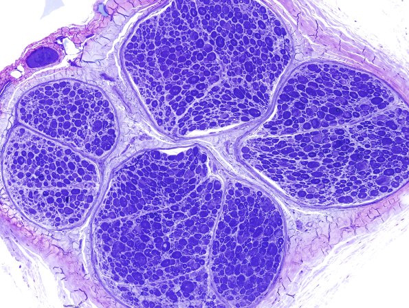 12C1 Artifact, crush compare with adjacent block same nerve Plastic 20X 2.jpg