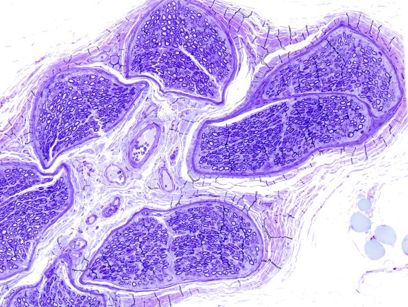 12C2 Artifact, crush compare with adjacent block same nerve Plastic 20X 1.jpg
