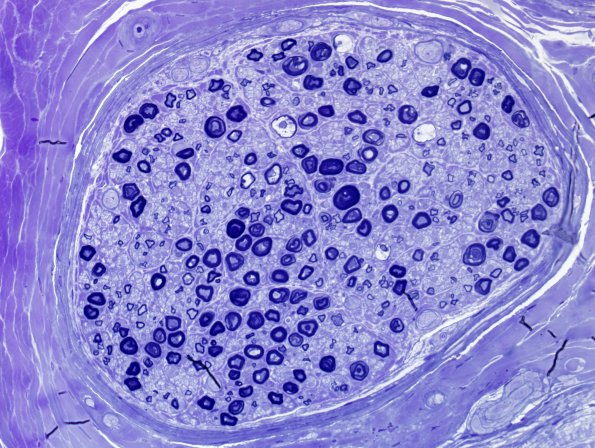 12D4 Artifact, crush Deeper sections Plastic 40X 2 (2)a.jpg