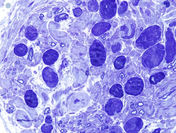 12F1 Artifact, nerve, crush Plastic 1.jpg