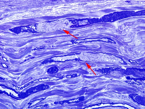 12F2 Artifact, nerve, crush Plastic 3 (2) copy.jpg