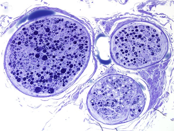 12G Artifact and axonal degeneration, active Plastic 2