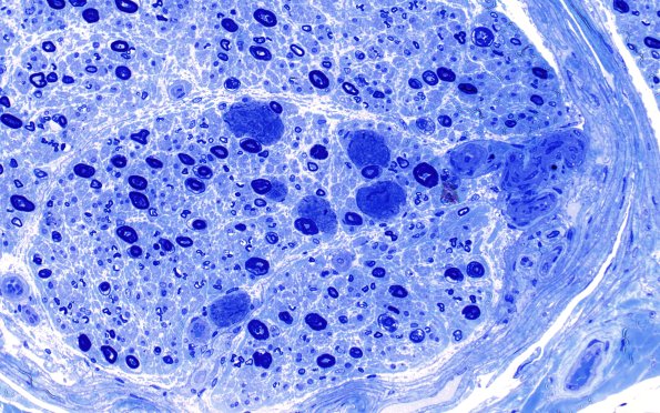 14A1 Artifact, Axon-Myelin compression Plastic 40X 3