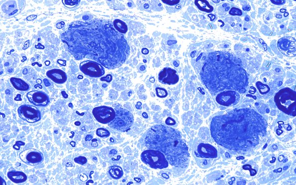 14A2 Artifact, Axon-Myelin compression Plastic 100X 1