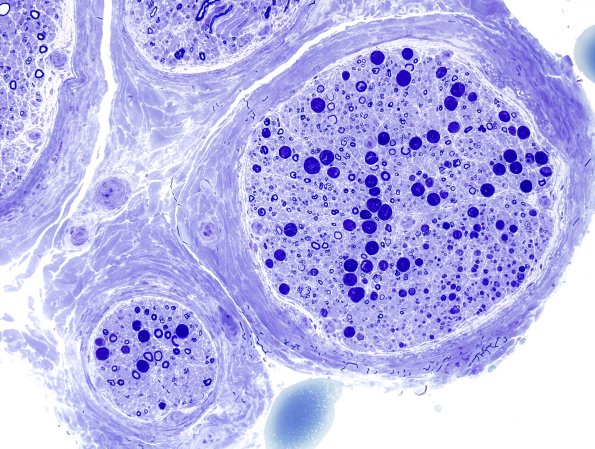 16A1 artifacts, crush & vesicular myelin Plastic 3.jpg