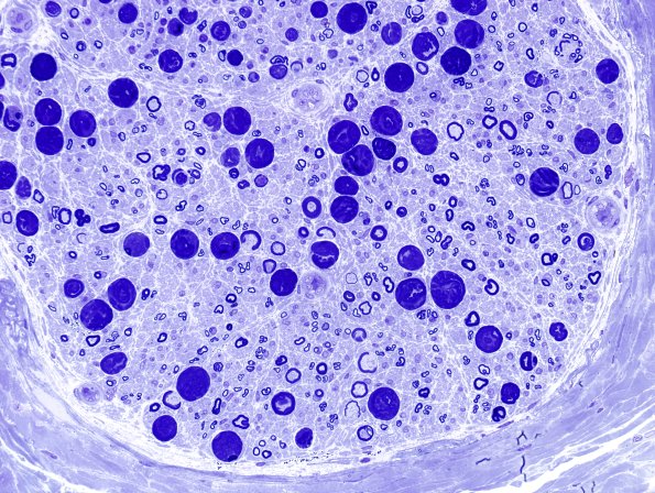 16A2 Artifacts, crush & vesicular myelin Plastic 4.jpg