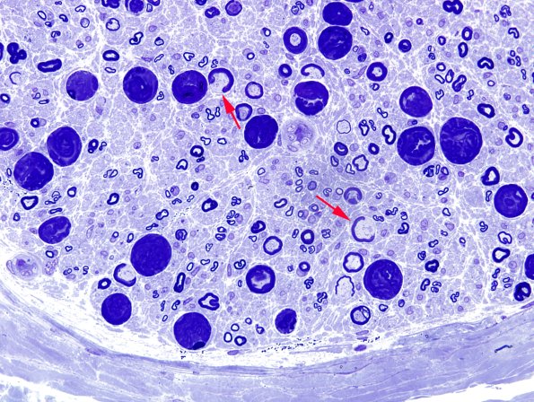 16A3 Artifacts, crush & vesicular myelin Plastic 5 copy.jpg