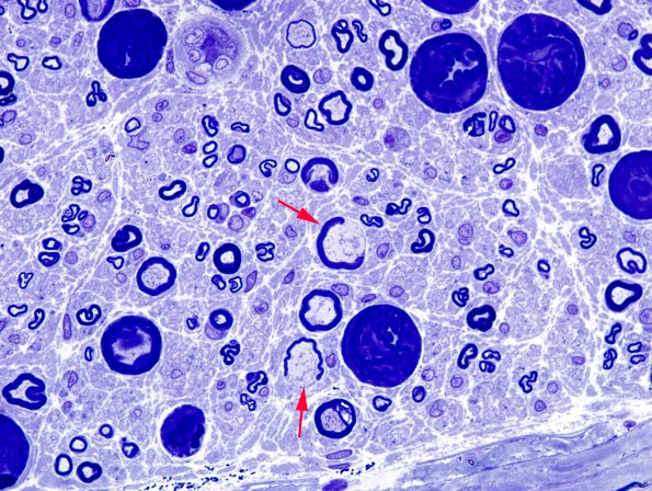16A4 Artifacts, crush & vesicular myelin Plastic 6 copy.jpg