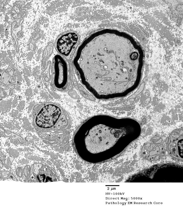 16B6 Artifacts, crush & vesicular myelin EM 012 - Copy