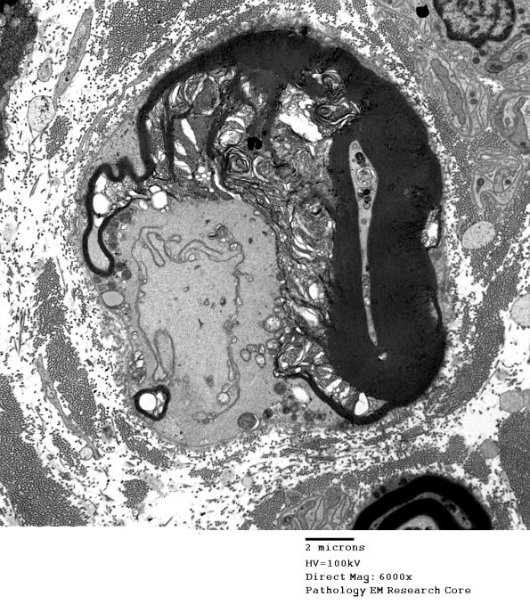 16D1 Axonal Degeneration EM 015 - Copy