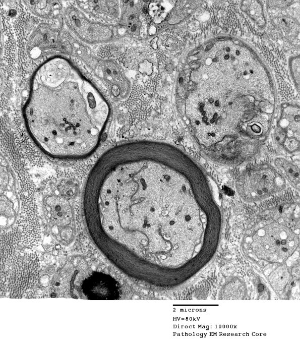 16F1 Axonal Degeneration, Honeycomb Pattern 020 - Copy