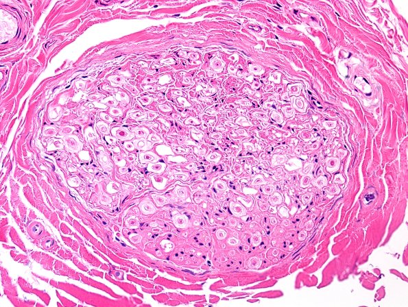 17A Artifact, delayed fixation, sural nerve H&E 1.jpg