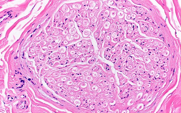 17B1 Vesicular Myelin Change Artifact H&E 40X 3