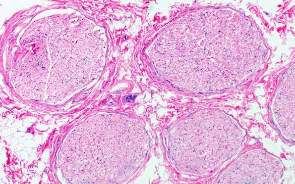17C1 Artifact, vesicular myelin, 6 days unfixed on wet gauze H&E 10X 5