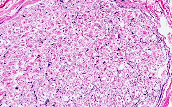 17C3 Artifact, vesicular myelin, 6 days unfixed on wet gauze H&E 40X 1
