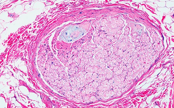 17C5 Artifact, vesicular myelin, 6 days unfixed on wet gauze H&E 40X