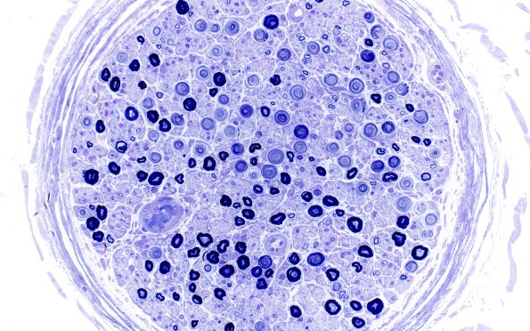 18A1 Artifact, crush Plastic deeper (40X)