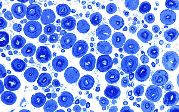 18B2 Artifact, vesicular myelin, 6 days unfixed on wet gauze Plastic 100X 4