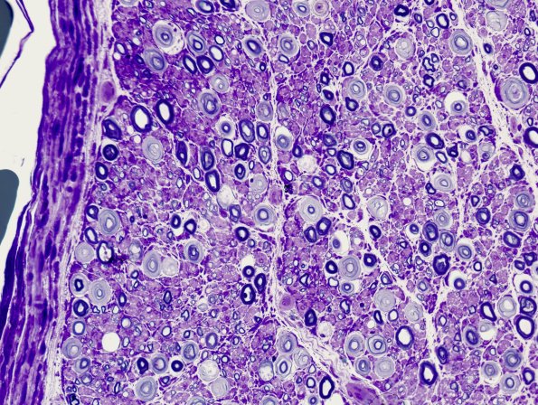 18C1 Artifact, delayed fixation -1