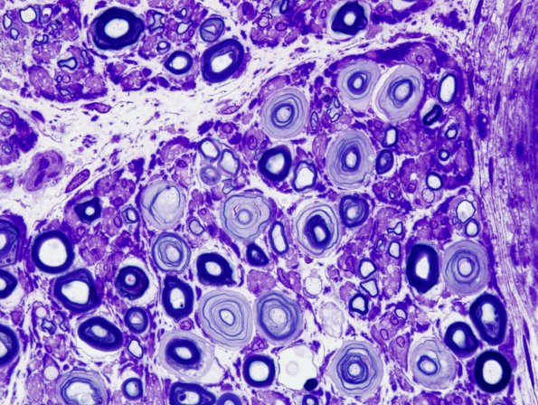 18C2 Artifact, delayed fixation -2A