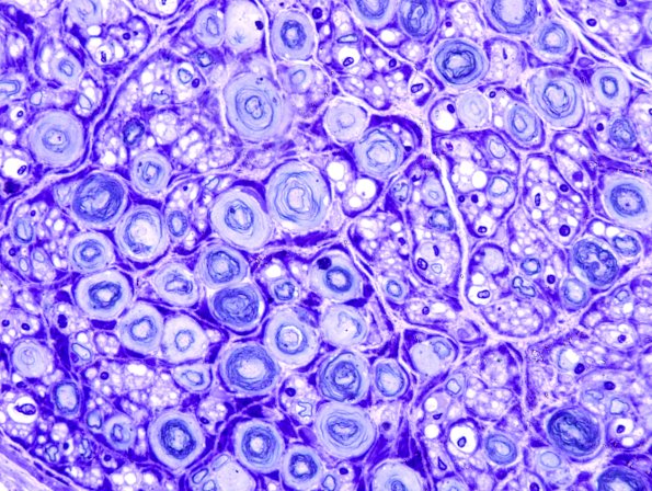 18D2 Artifact, delayed fixation Plastic 2