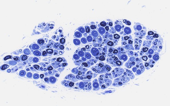 18E1 Vesicular Myelin Plastic 2