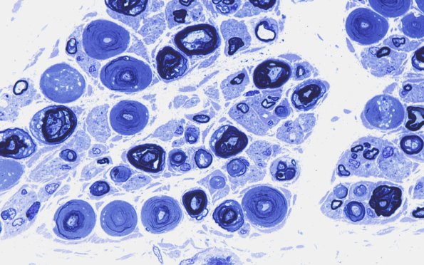 18E2 Vesicular Myelin Plastic 1