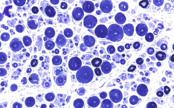 18F1 Artifact, vesicular myelin Plastic 2A