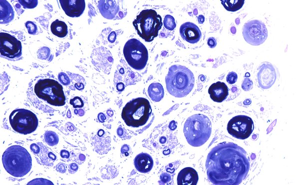 18F2 Artifact, vesicular myelin Plastic 5